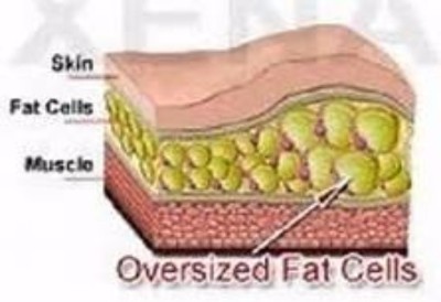 oversized fat cells